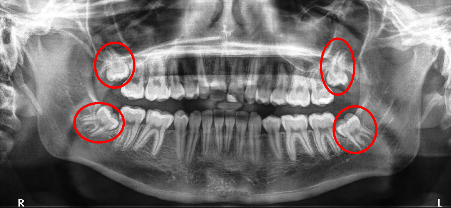 impacted wisdom teeth panoramic